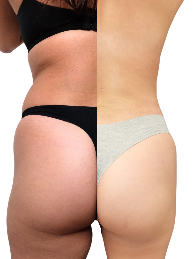 lipofilling