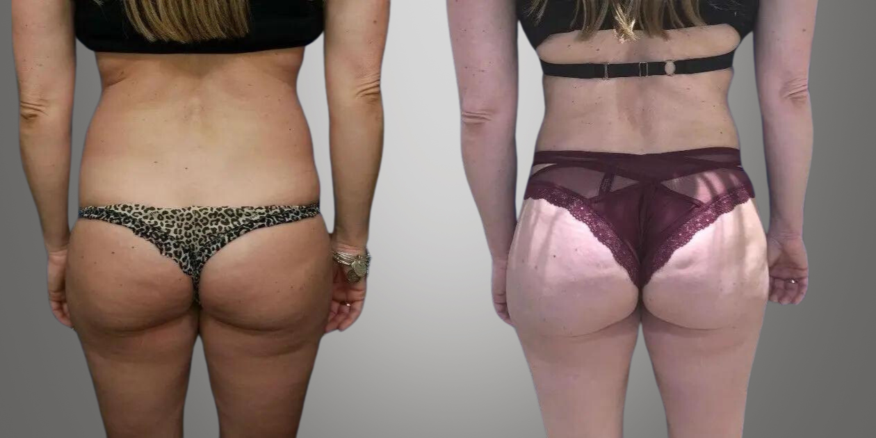 liposuccion