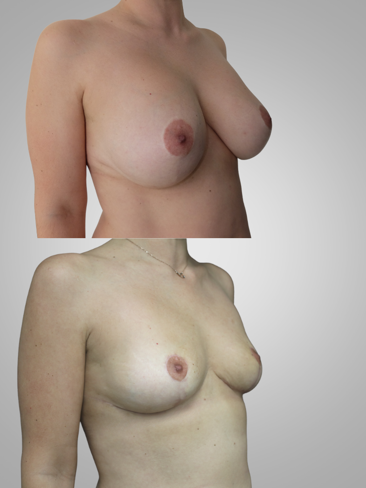 réduction mammaire