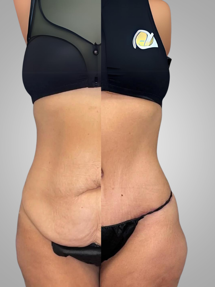 abdominoplastie