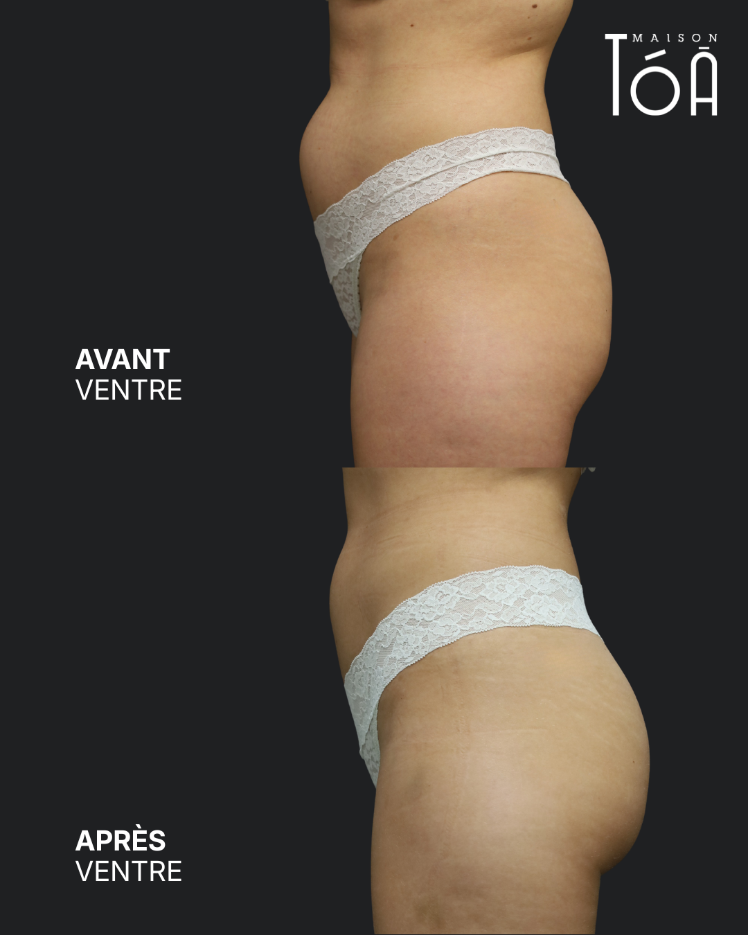 Avant Après Coolscuplting