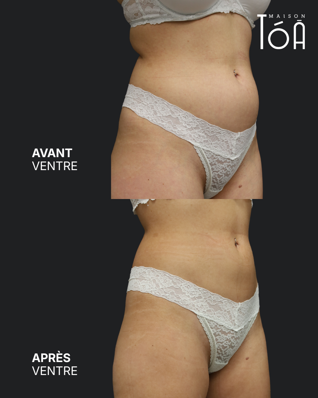 Avant Après Coolscuplting