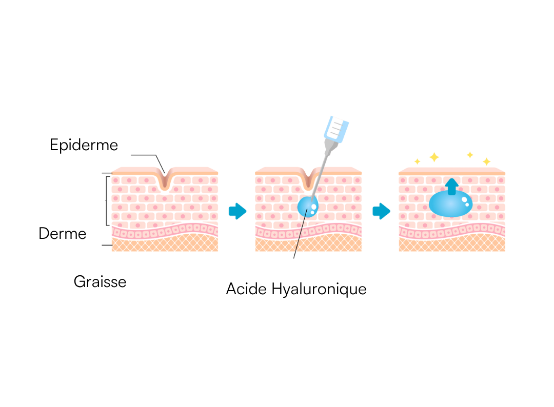 skinbooster processus