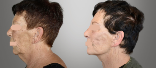 Lifting fils tenseurs